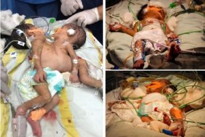 Doctors successfully separate conjoined twins at AIIMS in Jodhpur