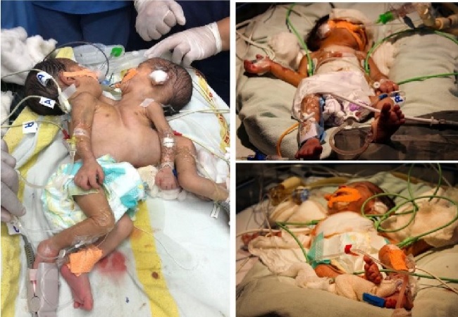 Doctors successfully separate conjoined twins at AIIMS in Jodhpur
