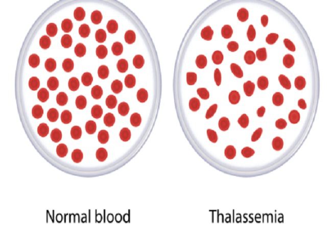 Thalassemia -