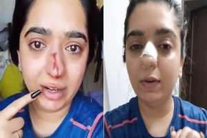 Bengaluru woman alleges Zomato delivery boy broke her nasal bone, shows bloody nose (Video)