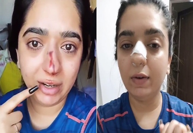 Zomato - are we really safe using ur services?: Bengaluru woman alleges delivery man broke her nasal bone