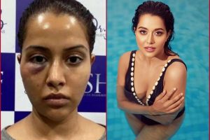 Tamil actress cosmetic procedure goes horribly wrong, seeks Rs 1 crore compensation from dermatologist
