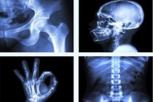 Steroid-infused bone death is the new post-COVID complication