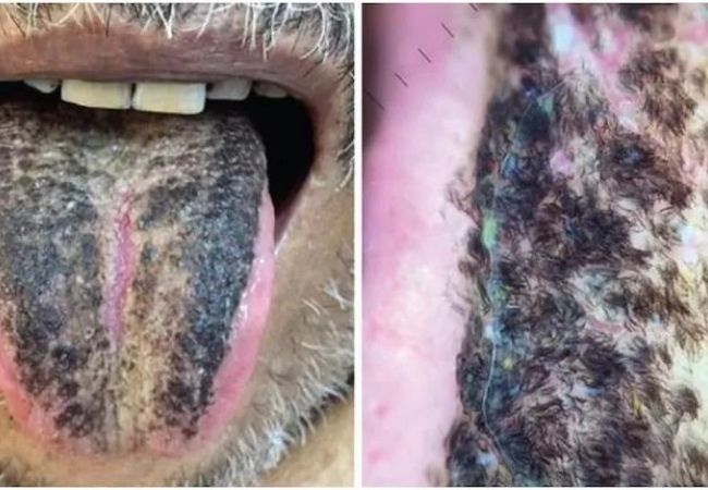 Man witness thick ‘black hair’ growing on tongue, seems like common medical condition to doctors
