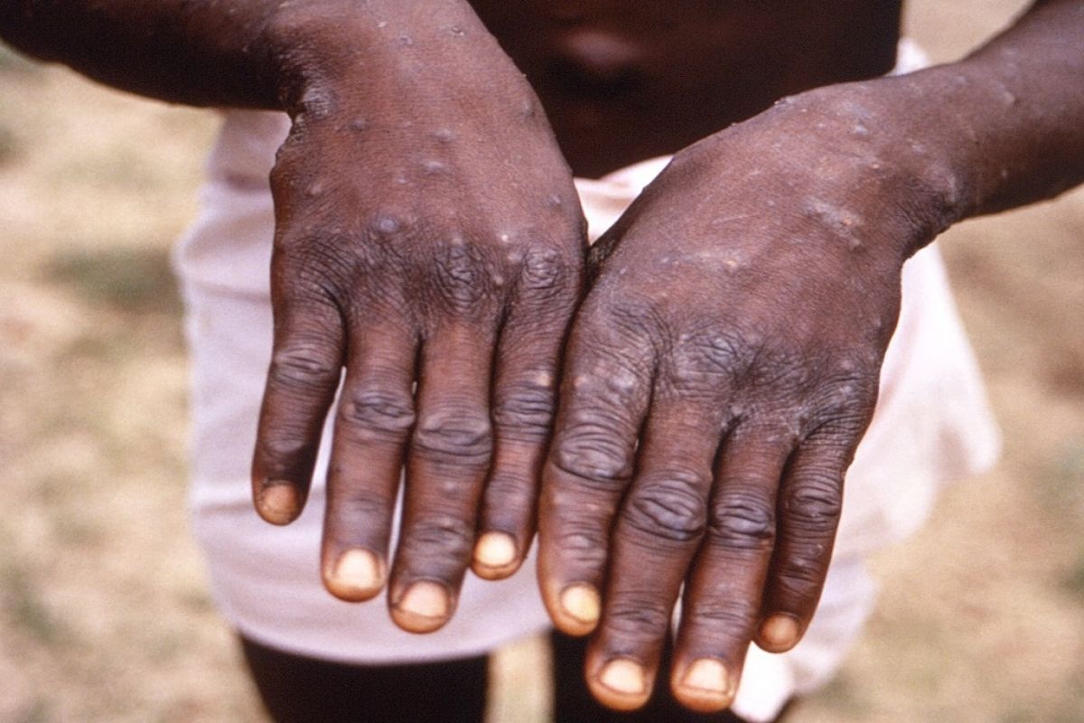 Delhi reports first case of Monkeypox with no travel history; fourth case of viral disease in India