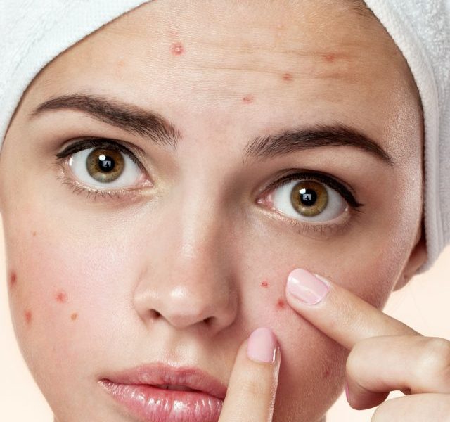 Pimples? Here is how to get rid of it naturally