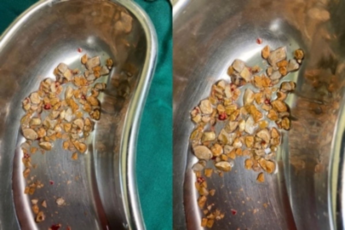 206 kidney stones removed from 56-year-old Hyderabad man [WATCH]