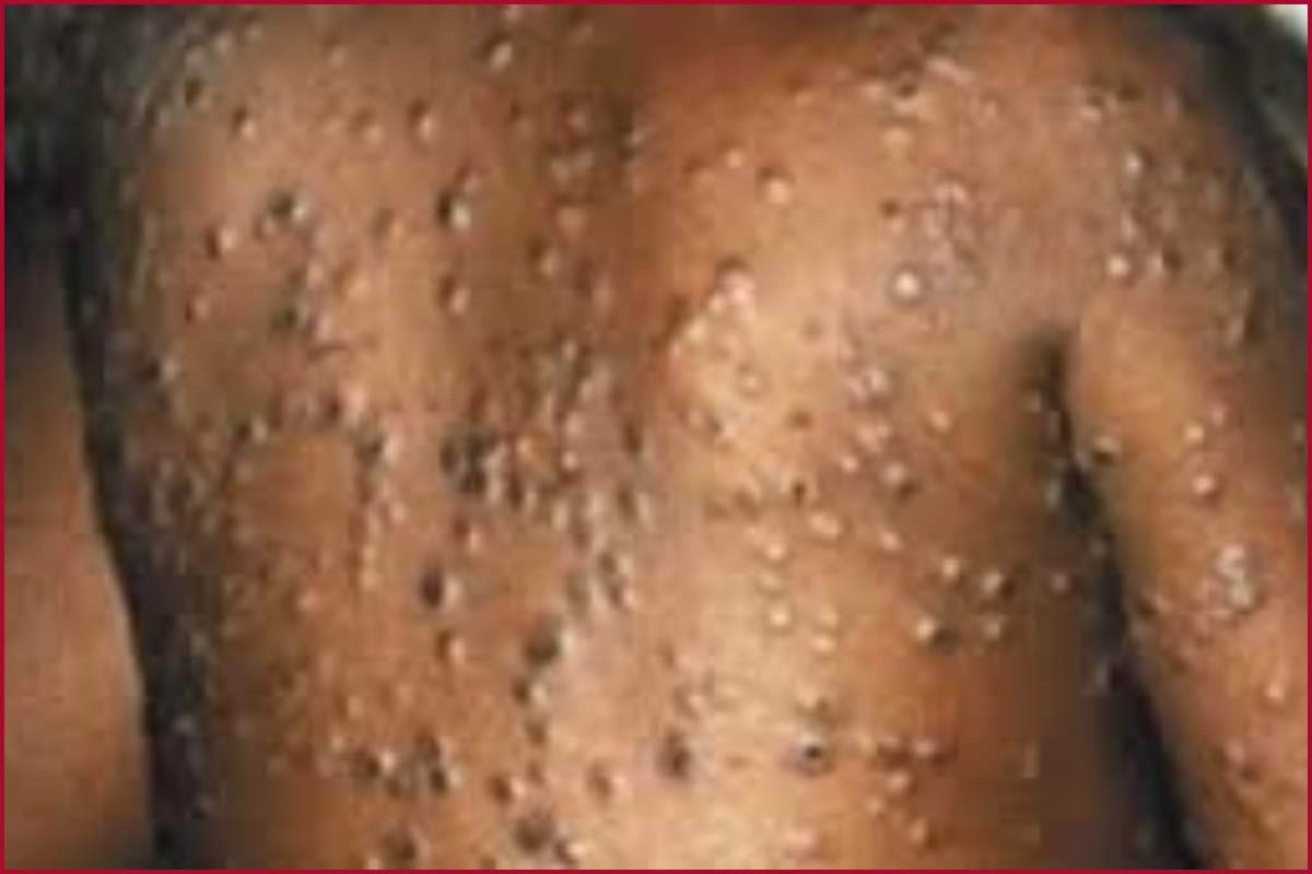 Massachusetts public health officials confirm case of monkeypox