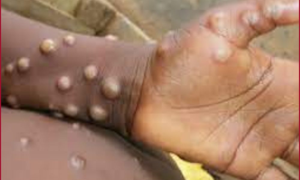 What is Monkeypox?; Check Symptoms, Cause and Treatment