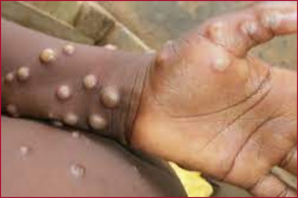 What is Monkeypox?; Check Symptoms, Cause and Treatment