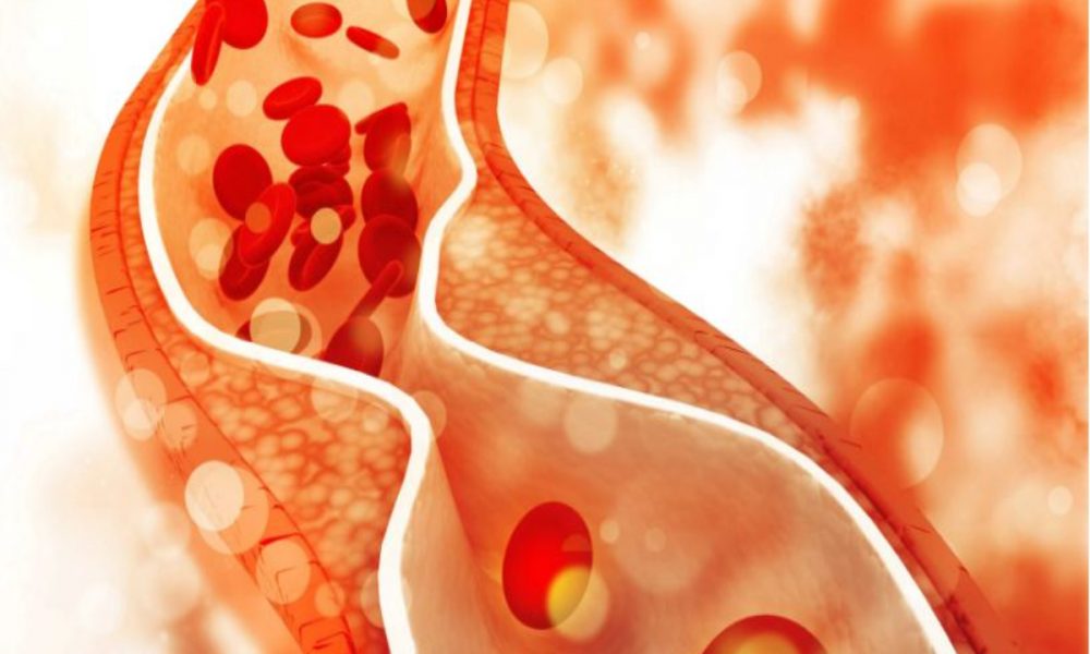 Follow these tips to control your high cholesterol