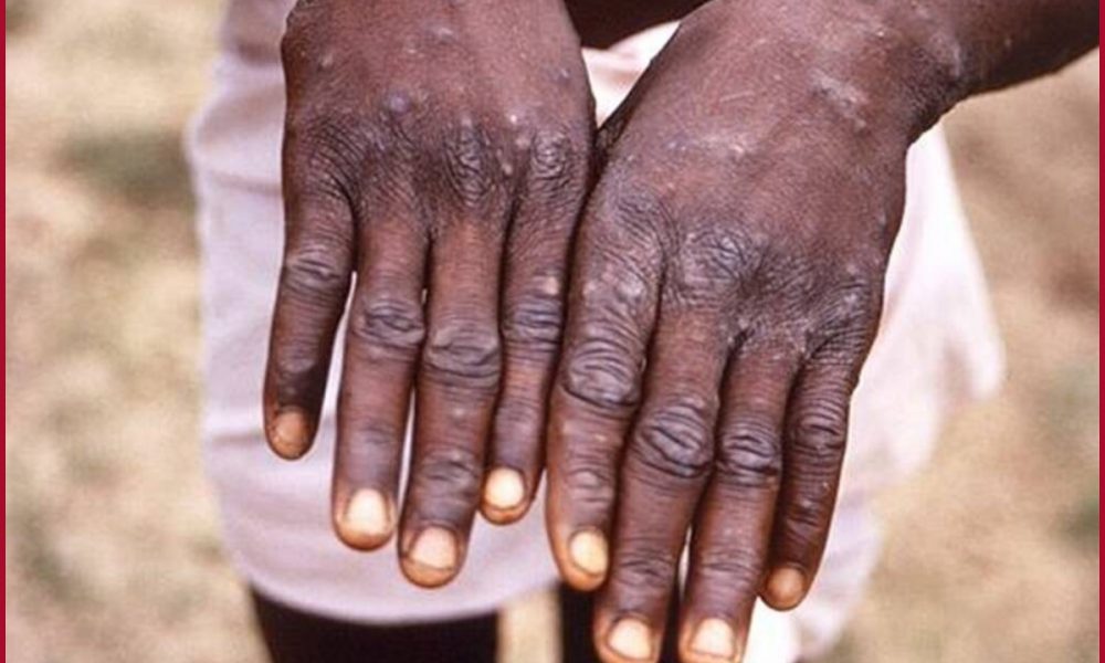 “We believe Monkeypox outbreak can be stopped”: WHO