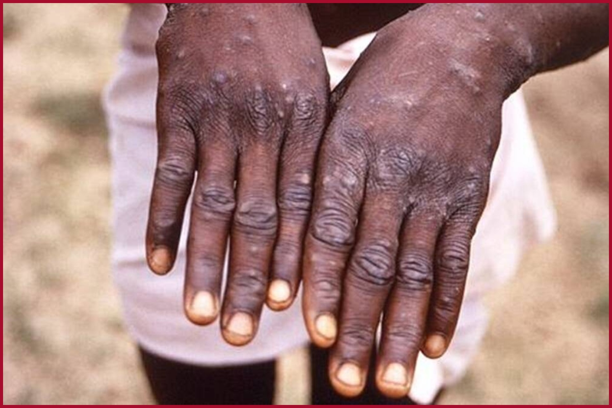 “We believe Monkeypox outbreak can be stopped”: WHO
