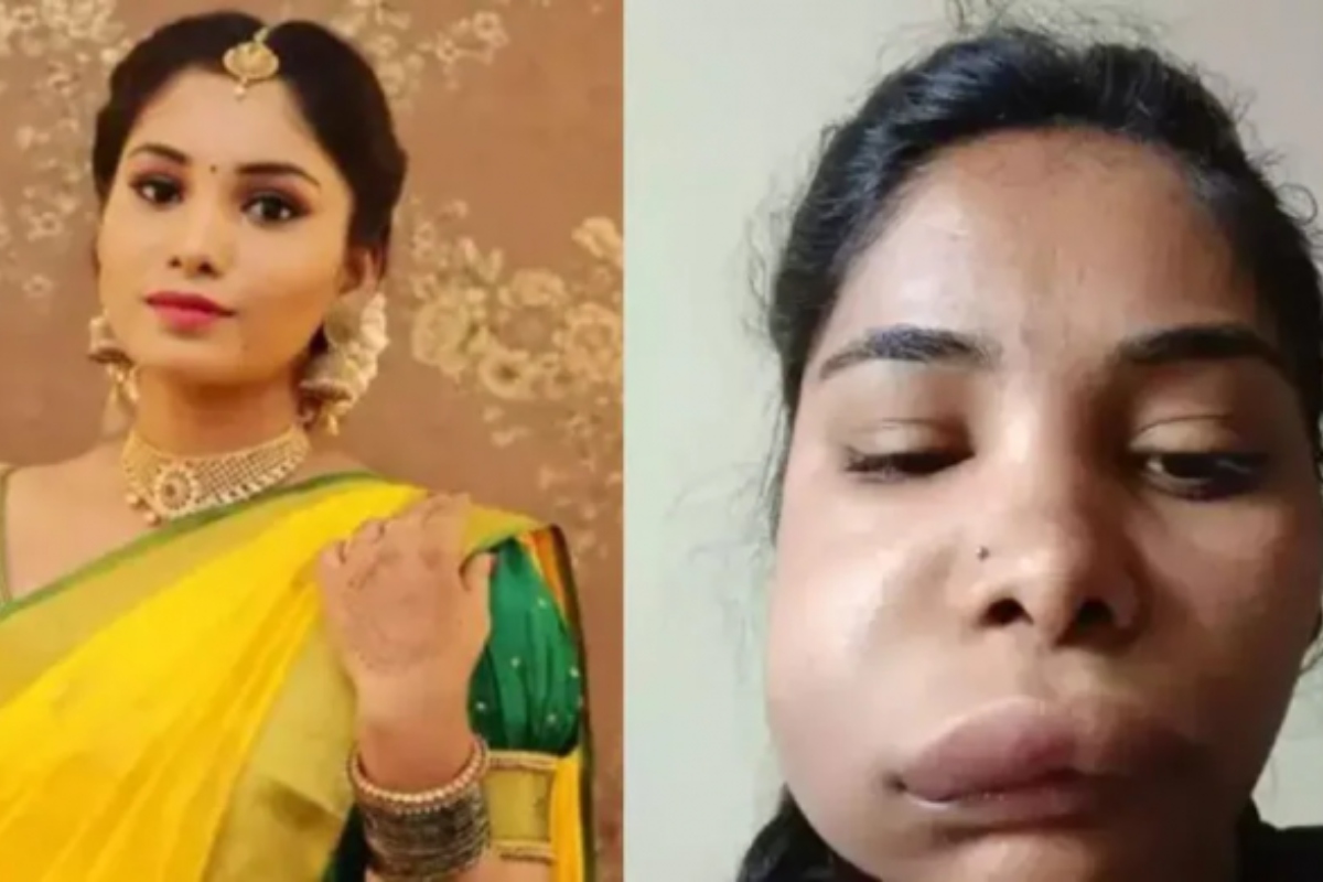 Kannada actress Swathi Sathish’s root canal surgery goes wrong, makes her look unrecognizable