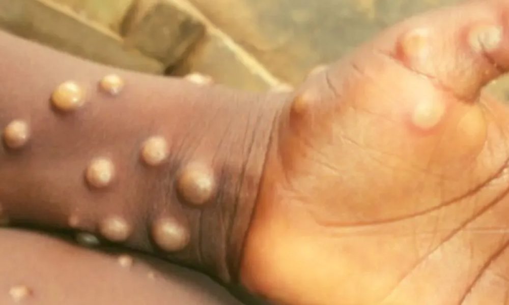 One youth dies with Monkeypox-like symptoms, Kerala health dept initiates inquiry