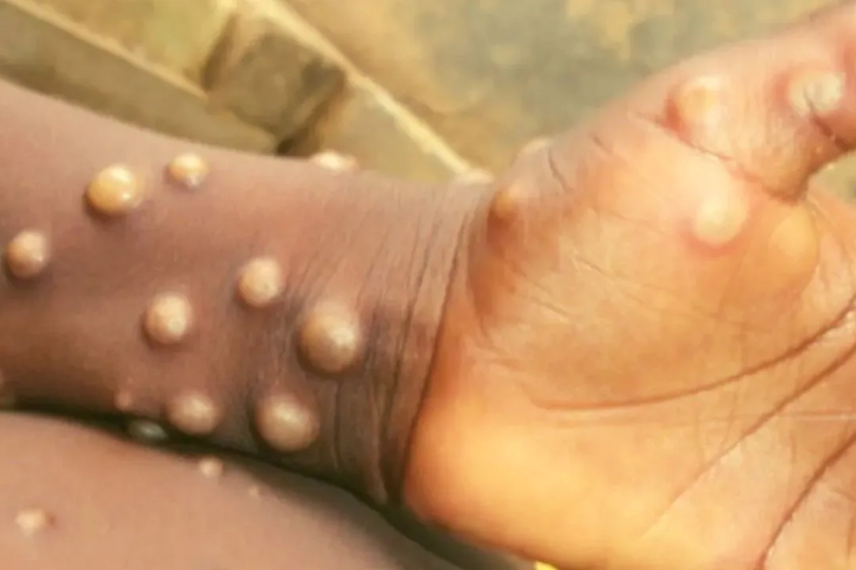 WHO to change the name of monkeypox? Here’s why