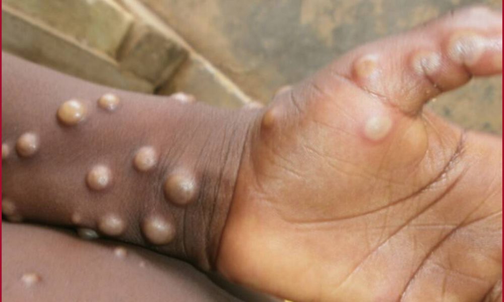Explained: Monkeypox is not as serious as Covid-19, though declared a health emergency