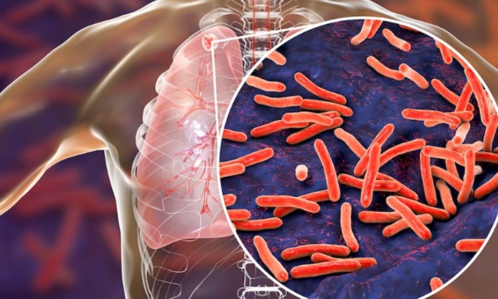 What is tuberculosis, and what are its different types?