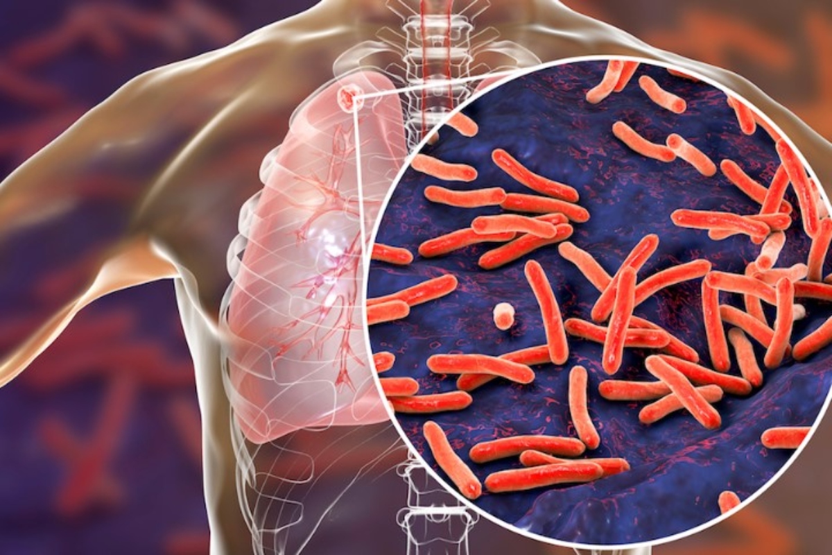 What is tuberculosis, and what are its different types?