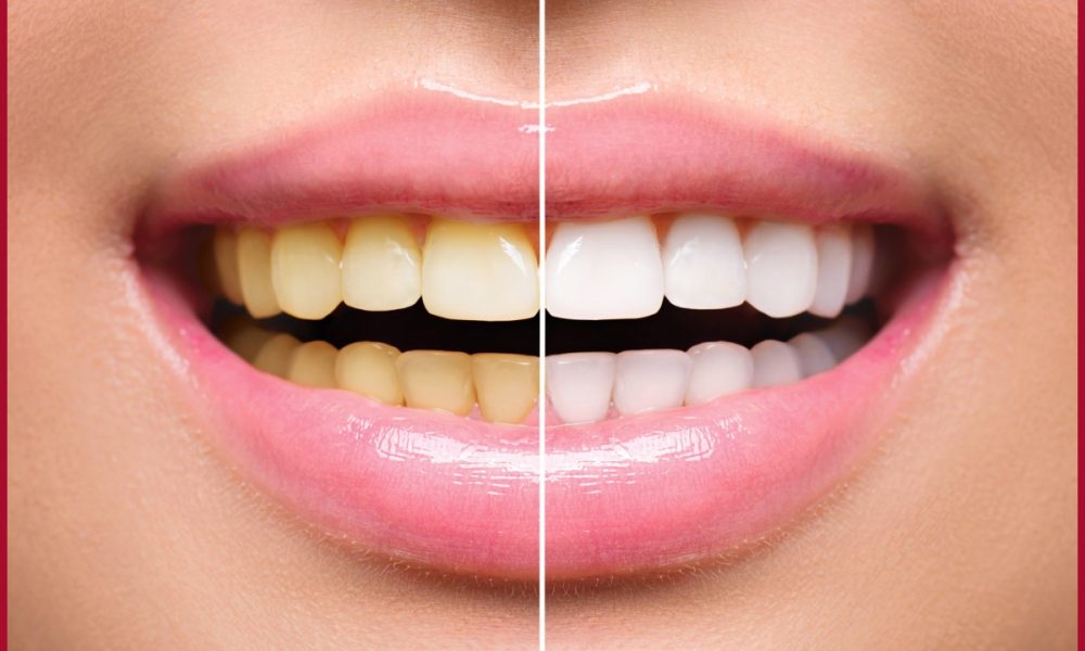Teeth Whitening: From cost to alternatives, check everything you need to know