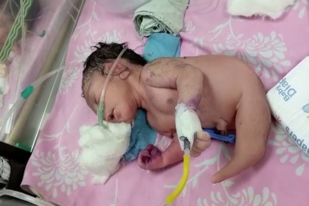 Baby born with horn-like structure instead of legs in Madhya Pradesh