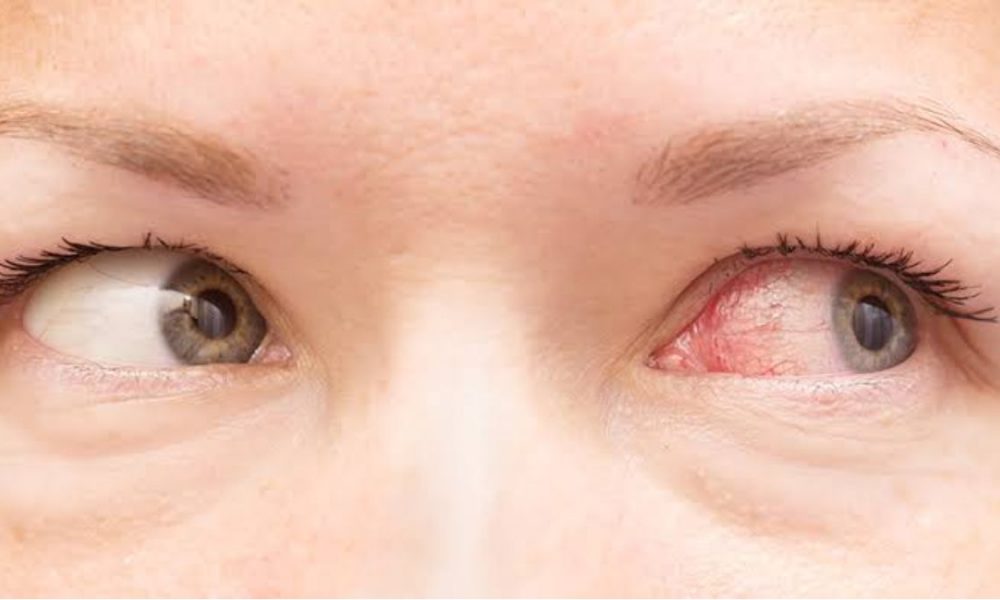 Conjunctivitis Outbreak: What are the symptoms; When to see a doctor | All you need to know about this rapidly spiking eye infection