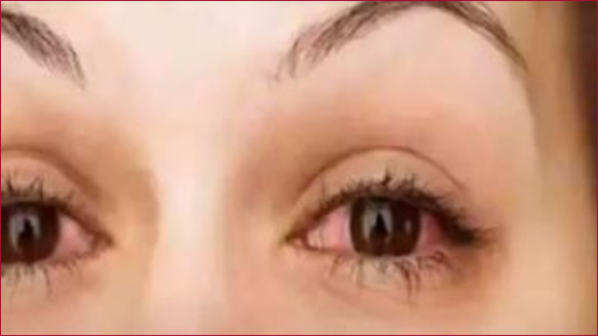 Home Remedies for Eye Flu: Here is the list of some products you can use to treat conjuctivitis