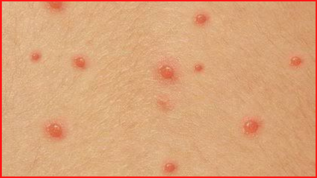New chickenpox variant “Clade 9” emerges in India: Symptoms and prevention