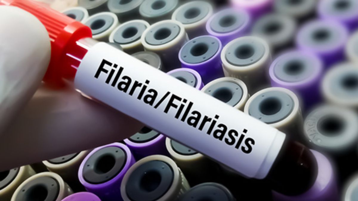 filariasis