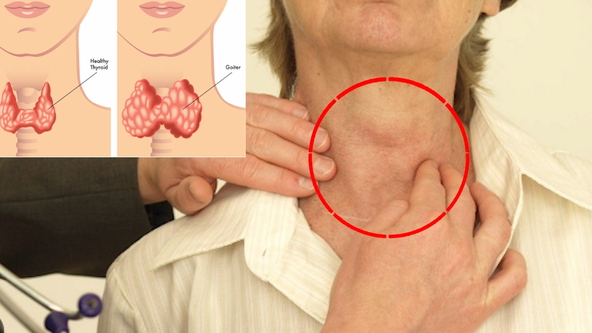 Signs of hypothyroidism that helps in early detection